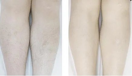 一般永久脱毛要多少钱