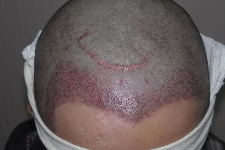 植发1000单位图片