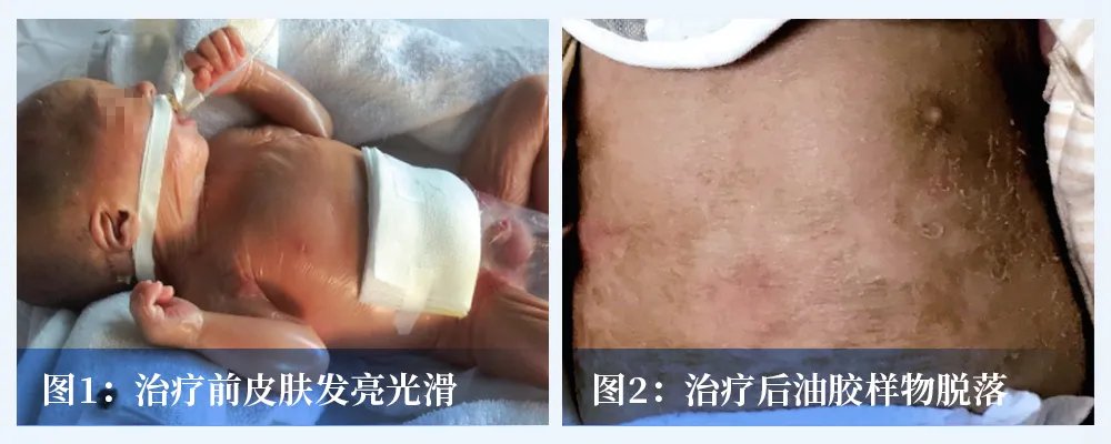 火棉胶婴儿是怎么导致的