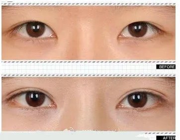 开眼角前后真人实拍对比照