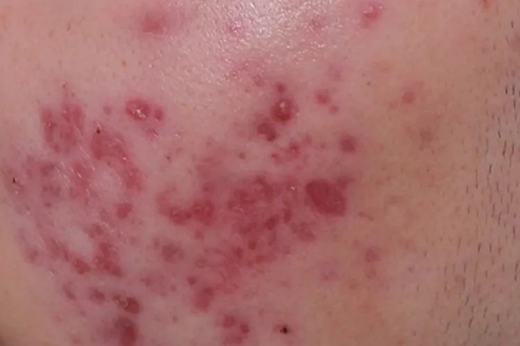 痘坑和痘印的区别图