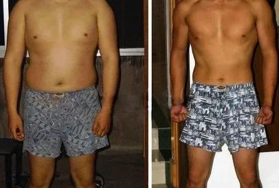 激光溶脂减肥好不好