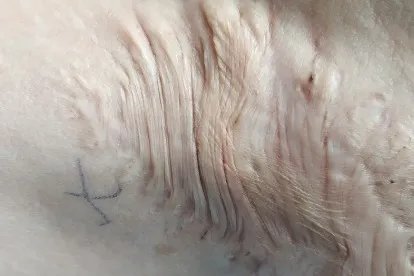 疤痕种类介绍及图片