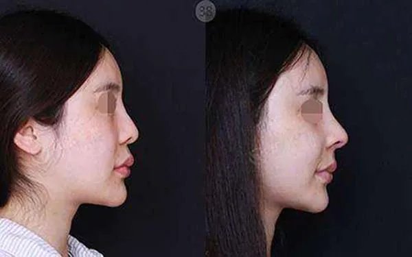 成都做鼻部手术整形哪个医院好