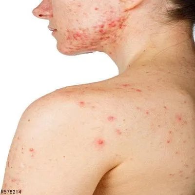 囊肿性痤疮的治疗方法有哪些