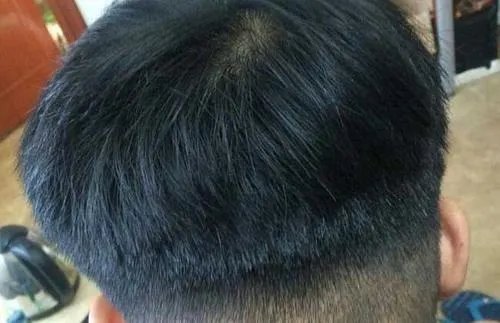 种植头发能保持多久