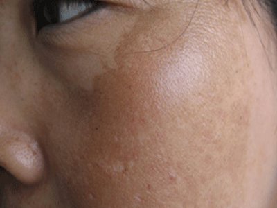 激光去除黄褐斑需要多少钱  