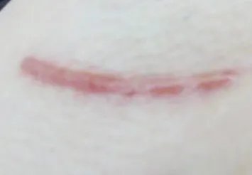 做疤痕增生修复费用大概需要多少