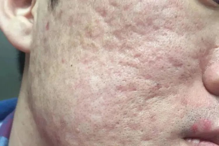 痘坑和痘印的区别图