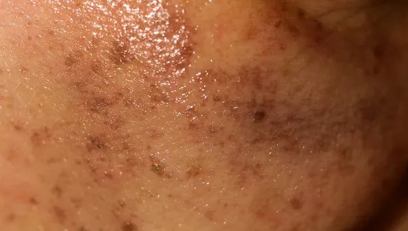 脸上长黄褐斑的原因