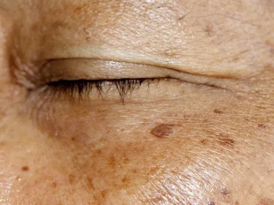 怎样治疗黄褐斑