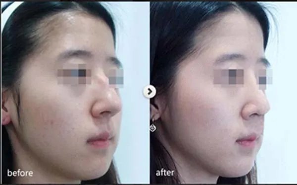 成都做鼻部手术整形哪个医院好