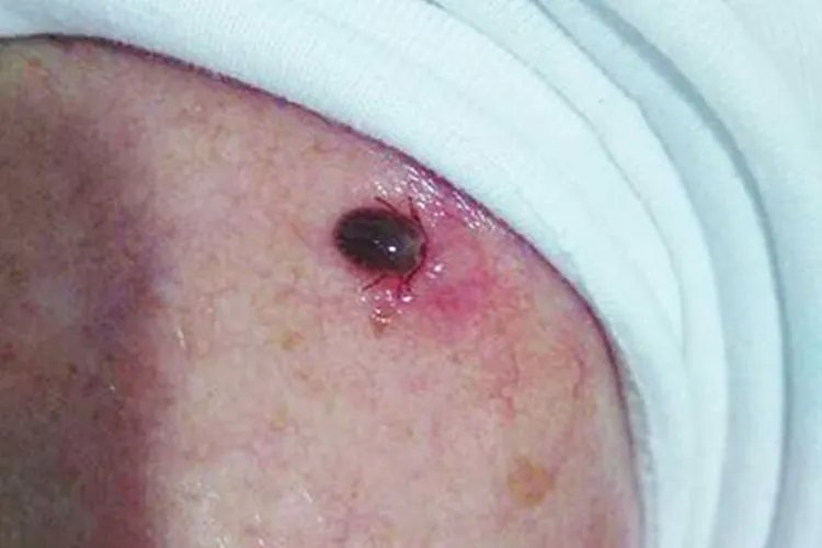 蜱虫咬人后有什么严重症状图片