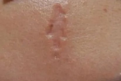 疤痕种类介绍及图片