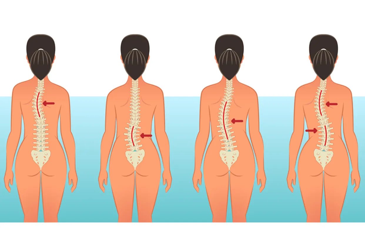 乳腺癌术后脊柱侧弯图片