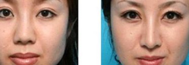 玻尿酸注射隆鼻费用高吗