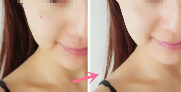 苏州做面部吸脂好的医院是哪家？