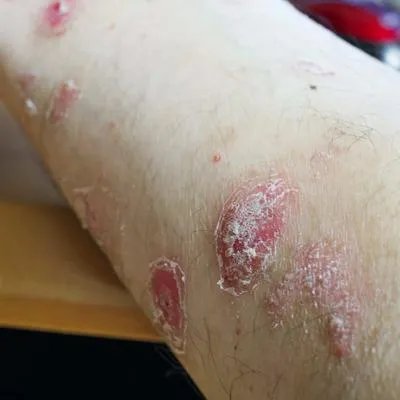 牛皮癣治疗小方法有哪些 四个方法有效控制牛皮癣