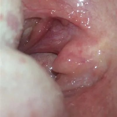 舌苔发白厚是怎么回事?