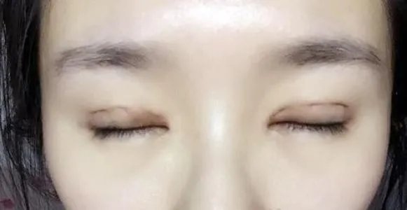 女子割双眼皮失败老公闹离婚，双眼皮手术哪种情况下算是很成功？