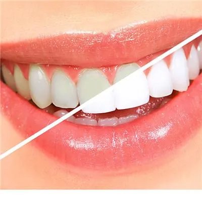 牙齿黄是什么原因造成的?