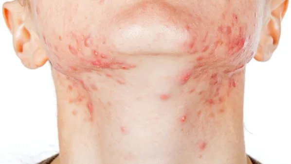 脸上长很小的痘痘怎么办