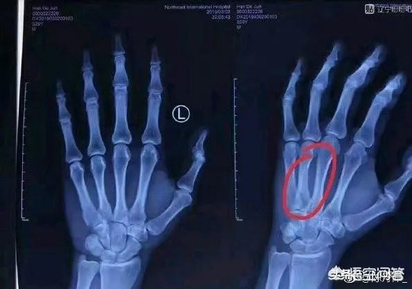 韩德君手指骨折需康复6周，最早会在半决赛复出，辽宁男篮有机会撑到半决赛吗？