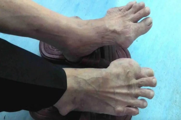 脚上痛风的位置示意图