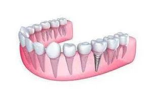 郑州种植牙多少钱一颗？哪里做种植牙好呢？