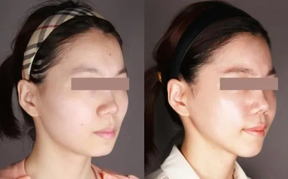 苏州做面部吸脂好的医院是哪家？