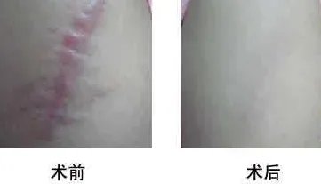 做疤痕增生修复费用大概需要多少