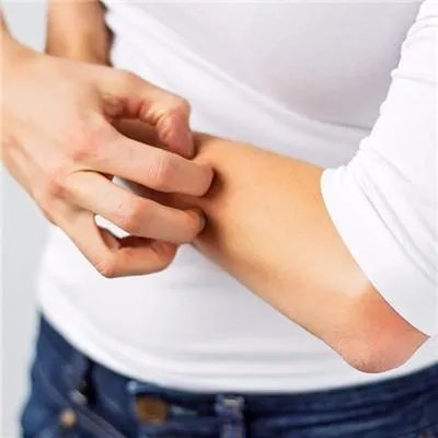 得了牛皮癣要怎么办才好