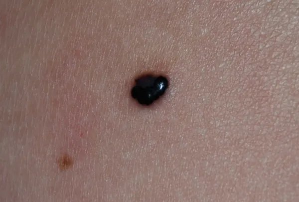 哪些痣是好痣？