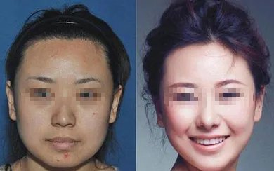 苏州做面部吸脂好的医院是哪家？