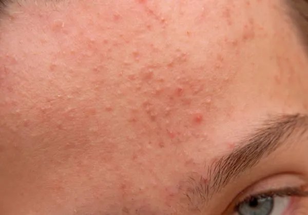 茶树精油有什么用 使用茶树精油要注意什么