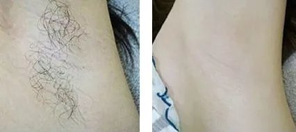 一般永久脱毛要多少钱