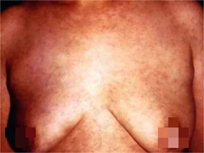 西瓦特皮肤异色病胸部红点图片