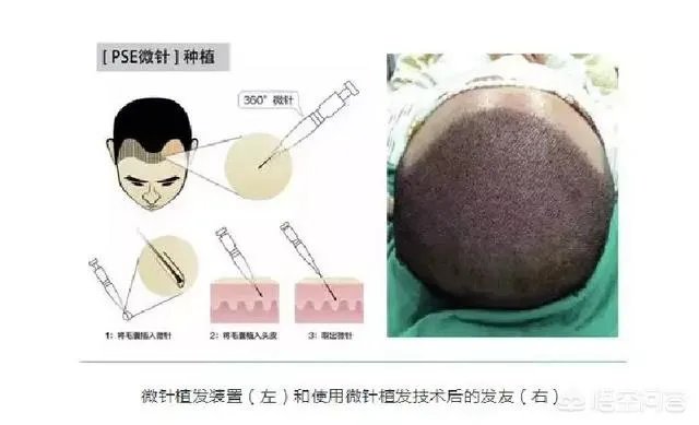 鲁尼植发大概花了多少钱？