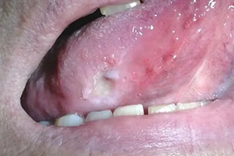 舌癌舌侧小坑图片