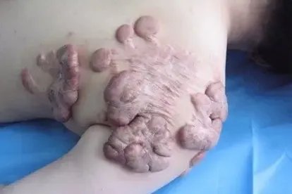 疤痕种类介绍及图片