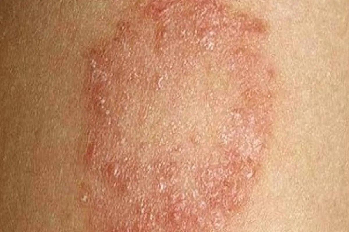 皮肤一圈一圈的癣图片