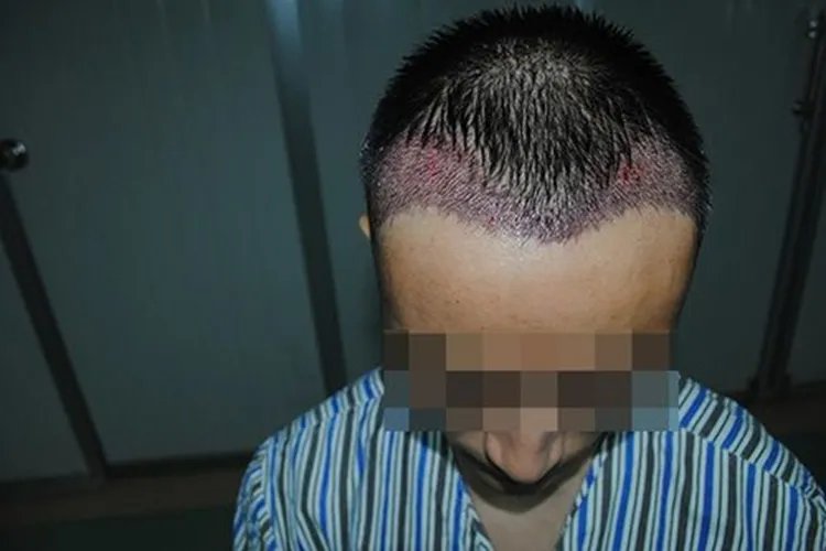 植发1000单位图片