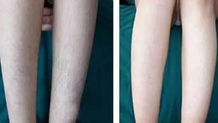 一般永久脱毛要多少钱