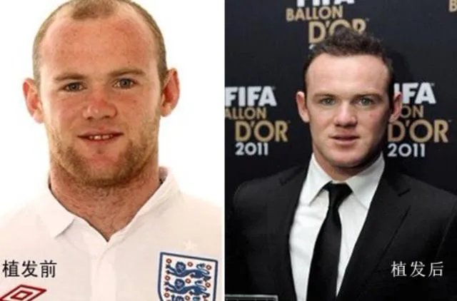 鲁尼植发大概花了多少钱？