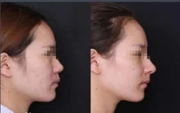 广州鼻子整容要多少钱