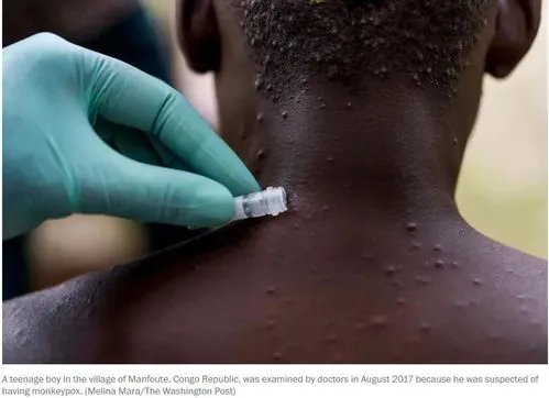 美国成世界上已知猴痘病例最多的国家，累计确诊5189例，为何如此严重？