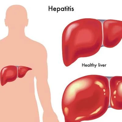 肝癌晚期中医如何治疗