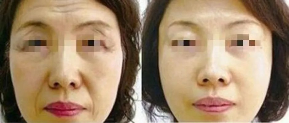 面部去皱多少钱