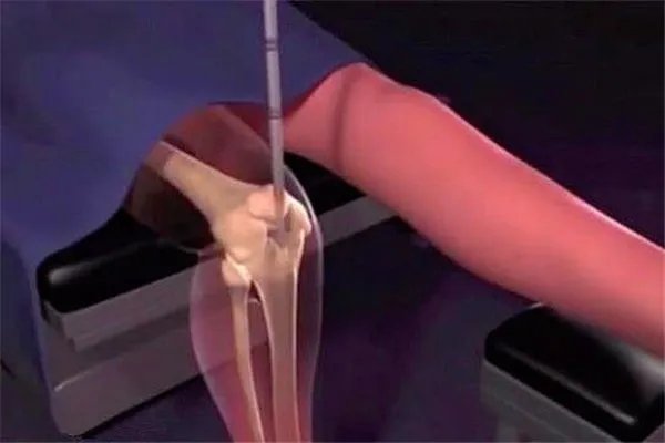 小伙身高不足一米八断骨增高致残疾，为何增高手术会致残？