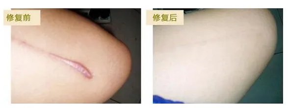 做疤痕增生修复费用大概需要多少